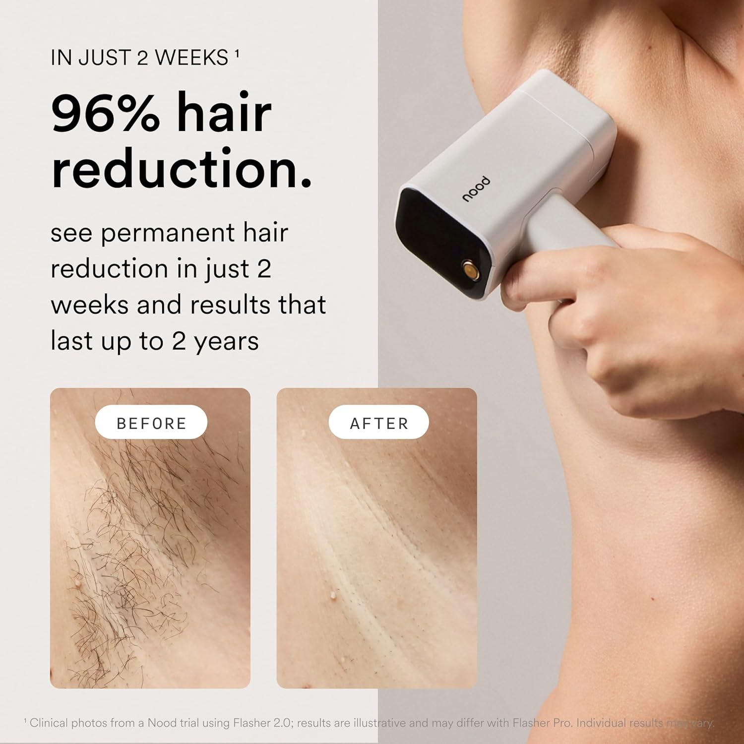IPL laser hair removal device in gloss white with included slow-grow serum for at-home hair removal — view 3